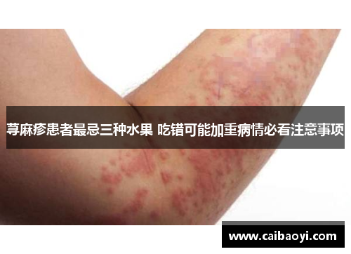 荨麻疹患者最忌三种水果 吃错可能加重病情必看注意事项
